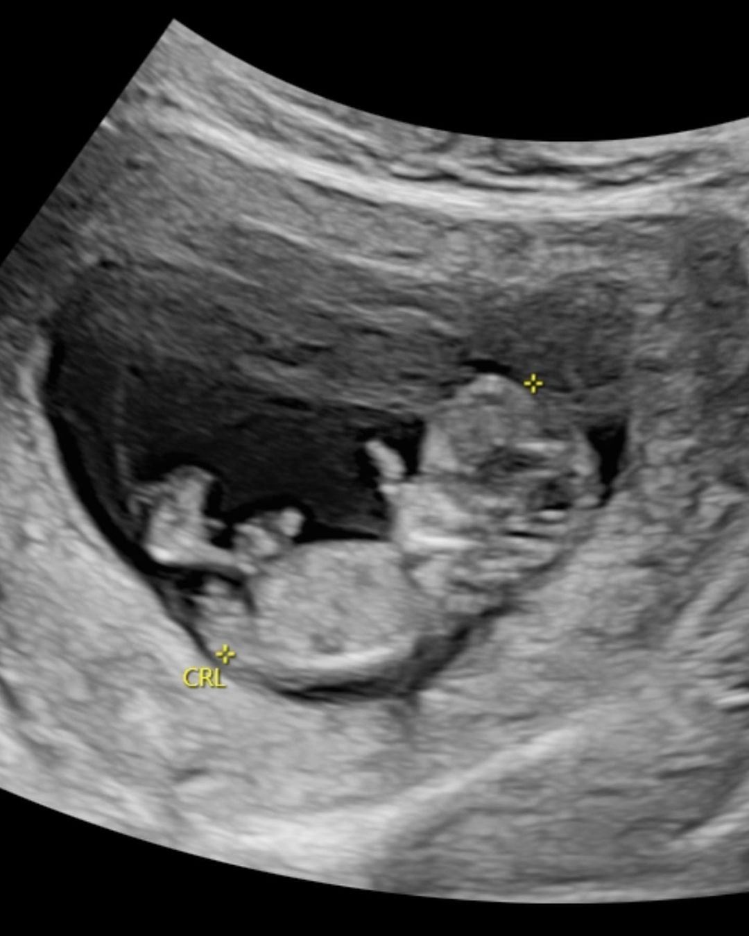 孫可芳分享懷孕初期的過程。