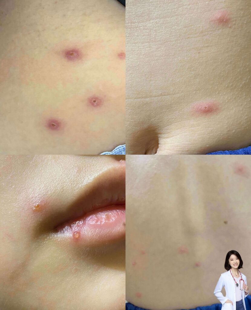 奇癢惱人的水痘，一旦得到會殘留病毒在體內，在免疫低下時發作成帶狀皰疹（圖片來源：兒科女醫艾蜜莉）