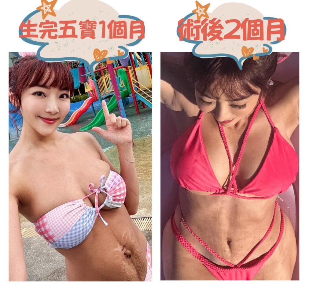 李宓動拉皮手術改善產後肚皮鬆垮問題。(圖片來源:李宓Mina 臉書)
