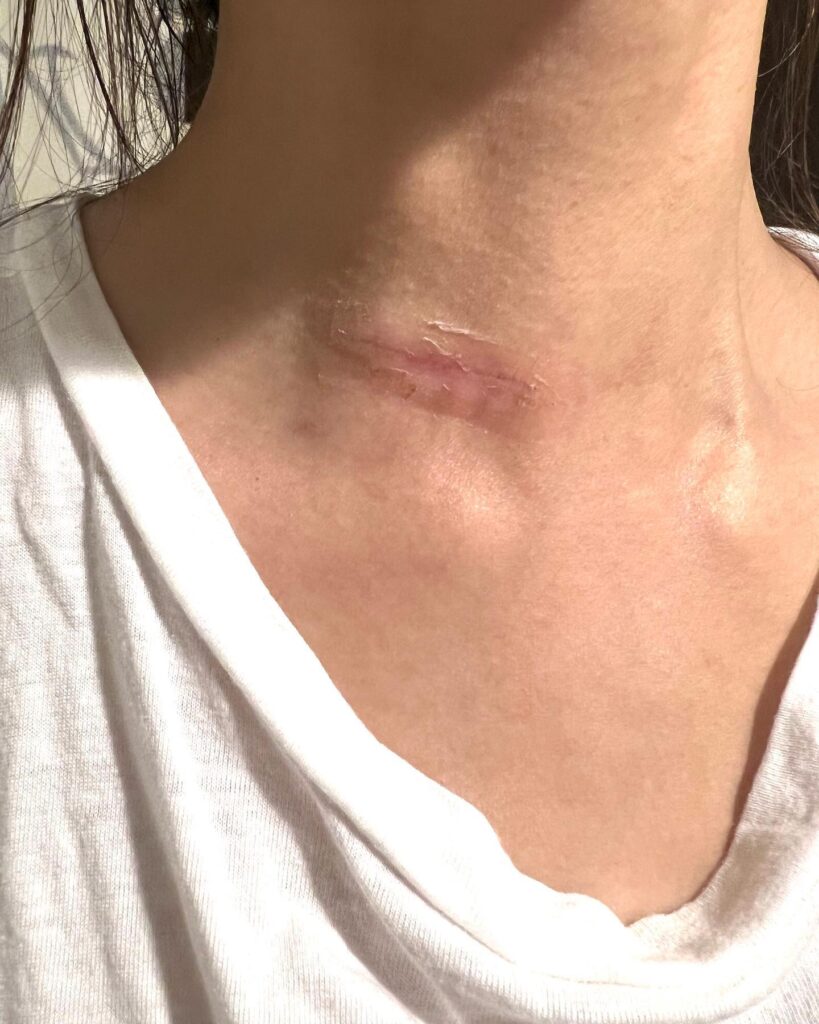 林欣霈健檢才發現身體出問題，動手術切除惡性腫瘤。（圖片來源：臉書 林欣霈-霈霈）