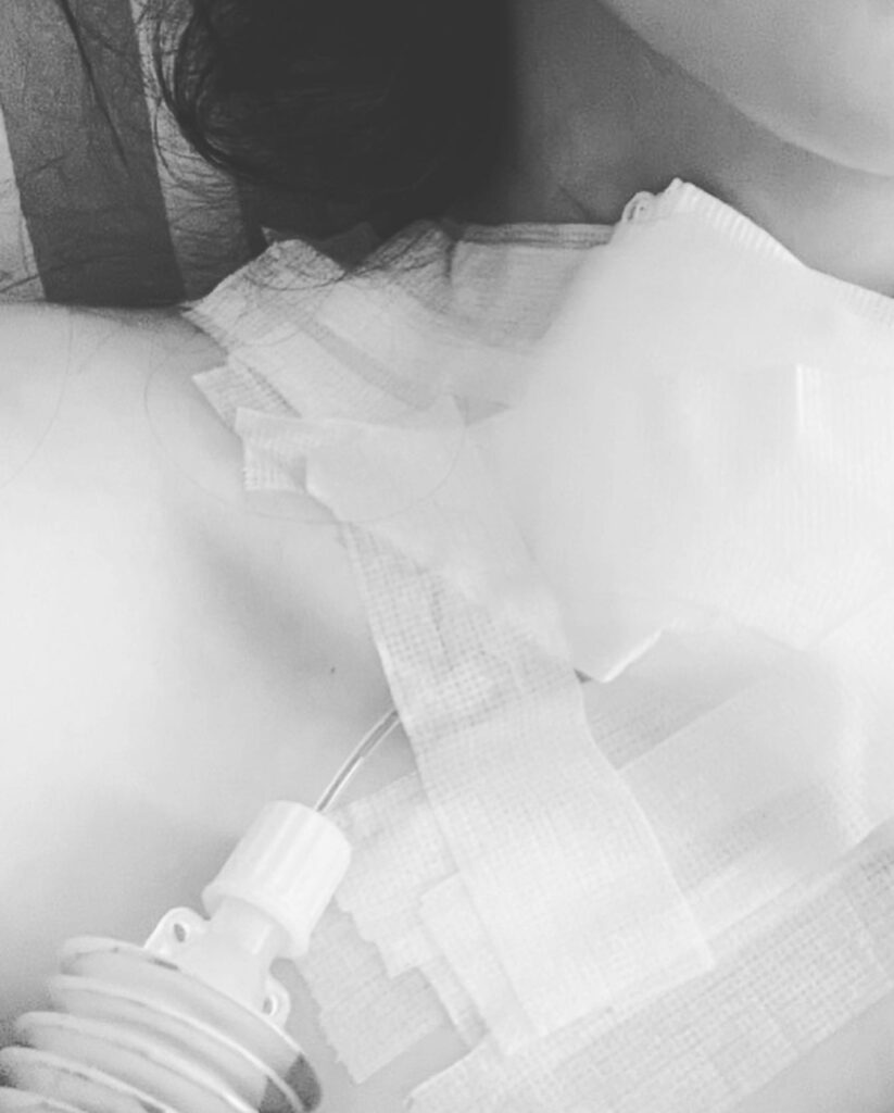 林欣霈開刀時已是第一期，所幸術後恢復良好。（圖片來源：臉書 林欣霈-霈霈）