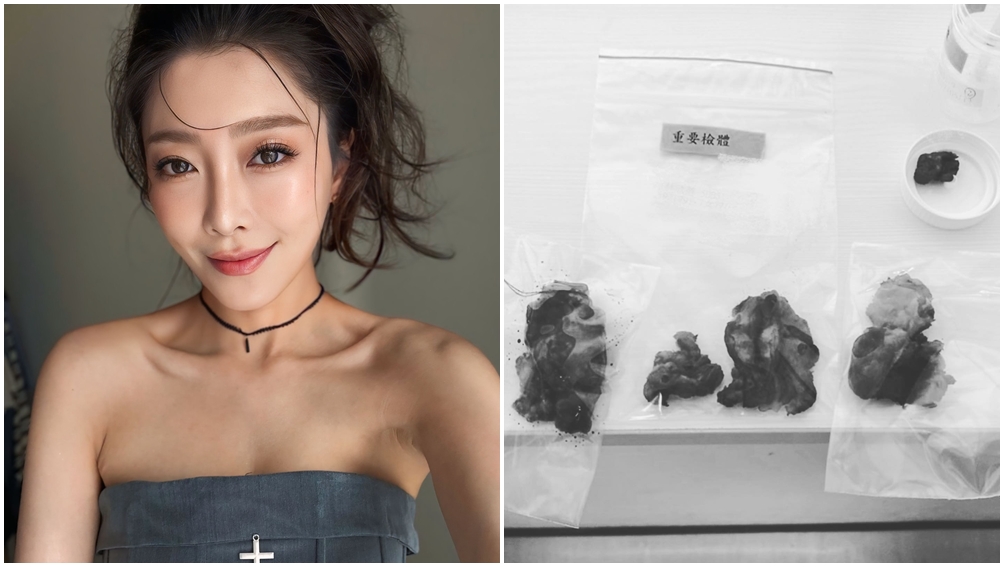 林欣霈在34歲那年發現罹患癌症，動手術切除甲狀腺。（圖片來源：臉書 林欣霈-霈霈）