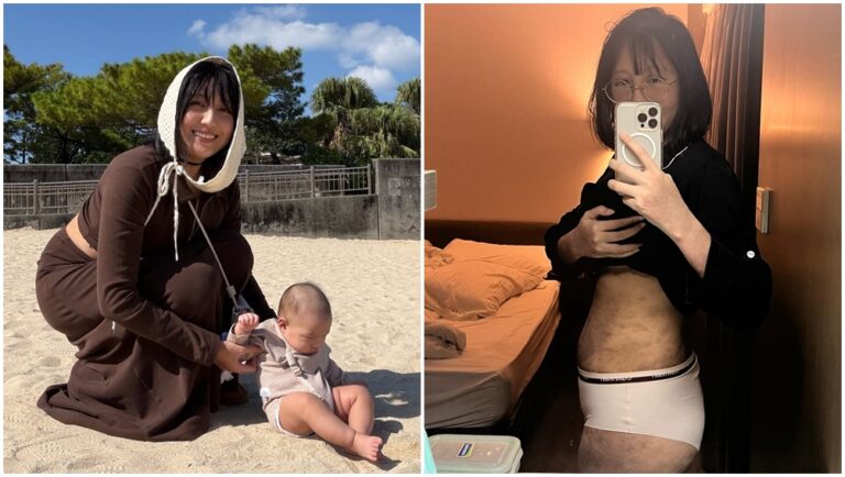 織織懷孕爆發異位性皮膚炎。（圖片來源：IG、Threads chichinote）