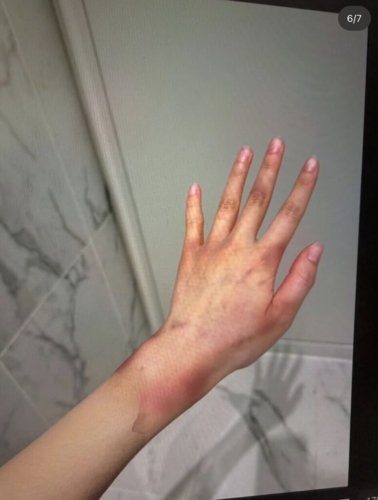 疑似Jisoo大嫂公開被家暴傷照。（圖片來源：IG）